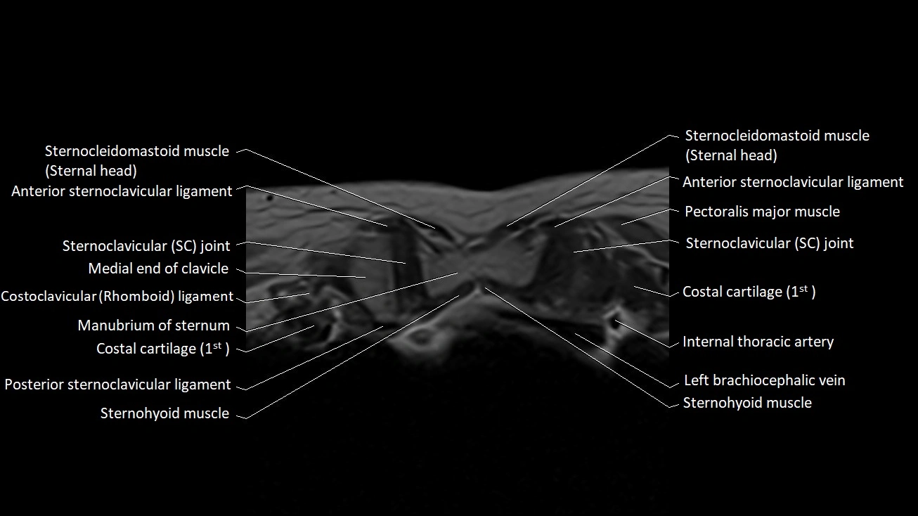 MRI sternum and sternoclavicular joint labeled axial anatomy image 5.webp